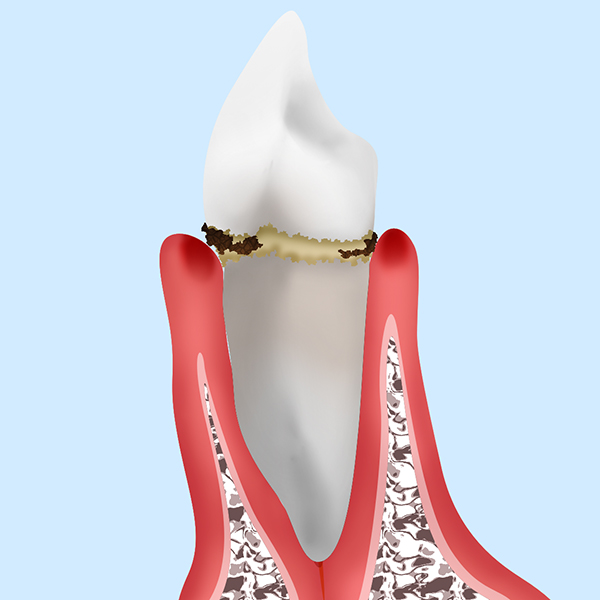 歯肉炎・軽度の歯周病