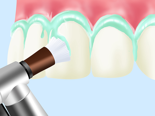 PMTC（Professional Mechanical Tooth Cleaning）